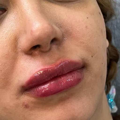 ژل لب و ورم در لحظه ی تزریق